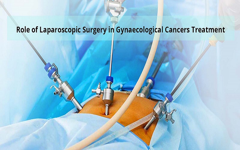 laparoscopic cancer surgery
