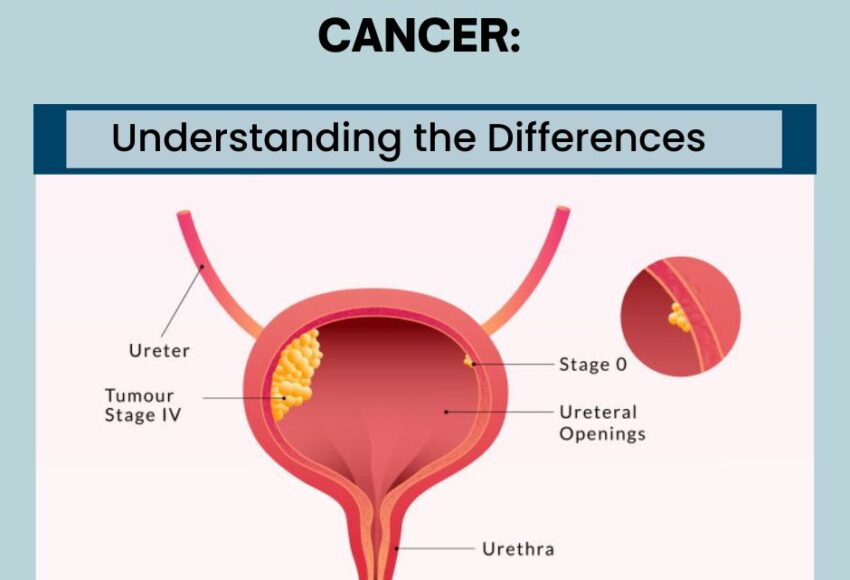 Types of Bladder Cancer | Dr Sumit Shah