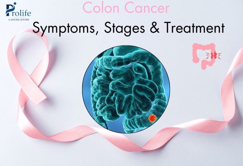 Colon Cancer: Symptoms, Stages & Treatment