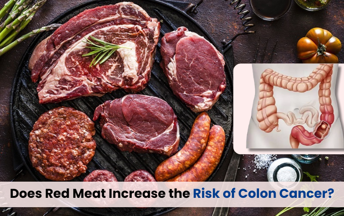 Does Red Meat Really Increase the Risk of Colon Cancer?