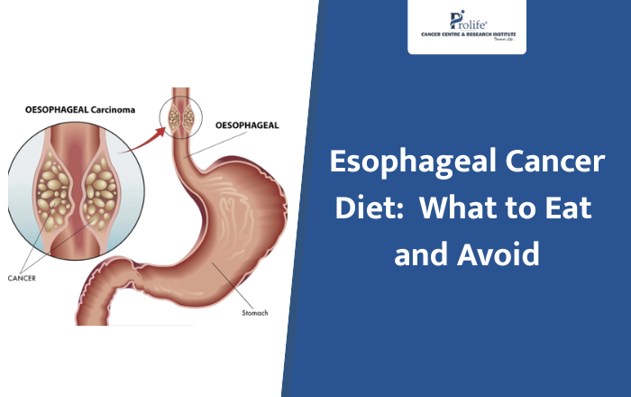 Esophageal Cancer Diet: Foods to Eat and Avoid During Treatment