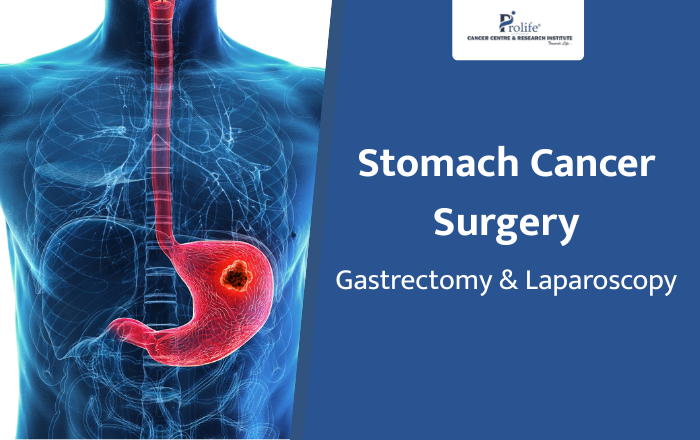Surgery for Stomach Cancer: Gastrectomy and Laparoscopic Options